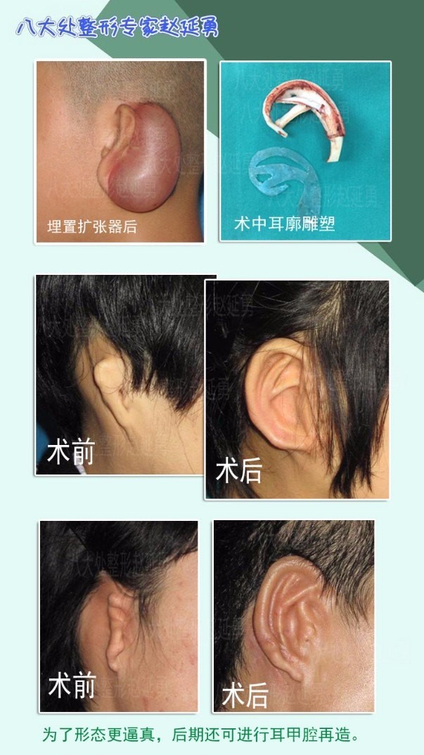  八大處整形趙延勇科普：皮膚擴(kuò)張法耳廓再造